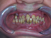 Extraction/dentures