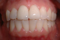 stained teeth image