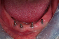 Mini Implant Retained Dentures