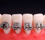 braces front teeth