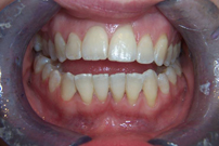 Extraction/dentures