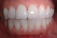 stained teeth image
